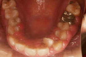 歯周病症例画像1