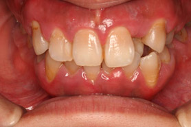 歯周病症例画像2